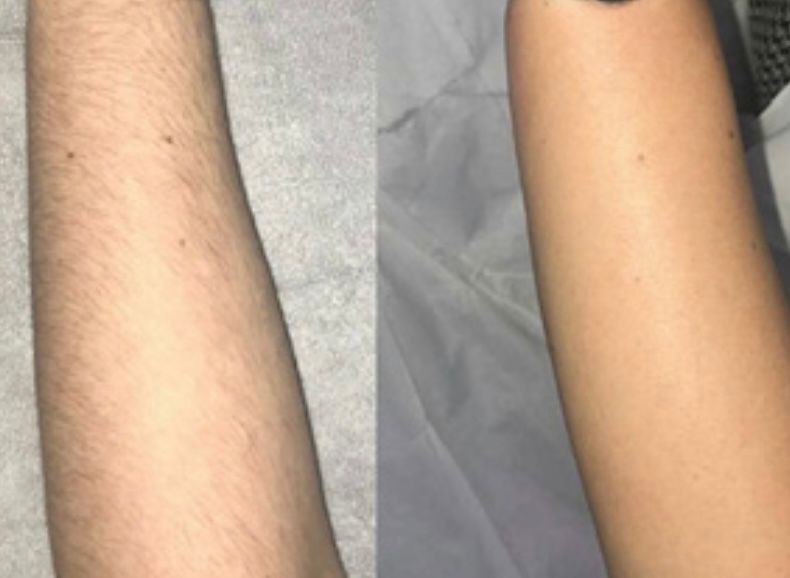 Laser Hair Removal at Get Beauty in Cambridge