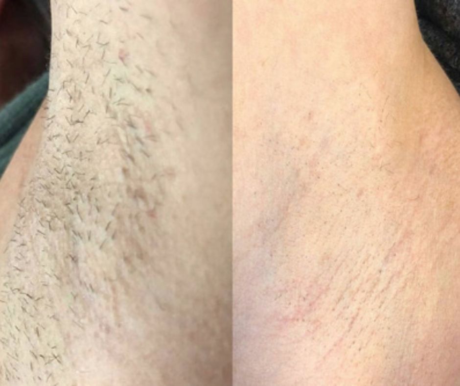 Laser Hair Removal at Get Beauty in Cambridge