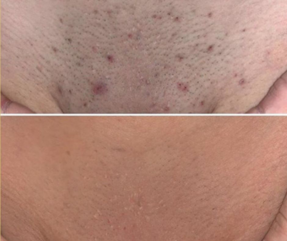 Laser Hair Removal at Get Beauty in Cambridge