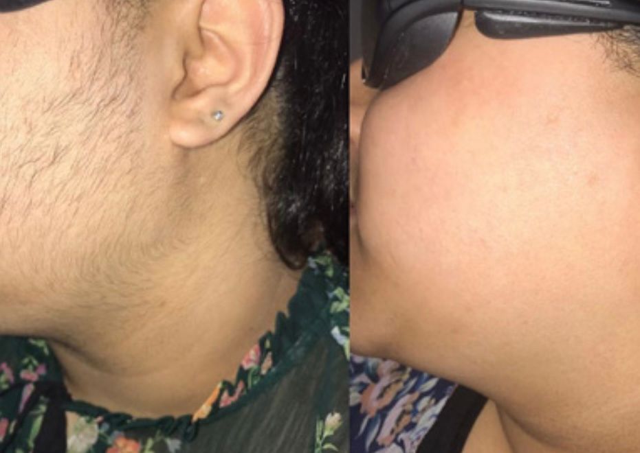 Laser Hair Removal at Get Beauty in Cambridge