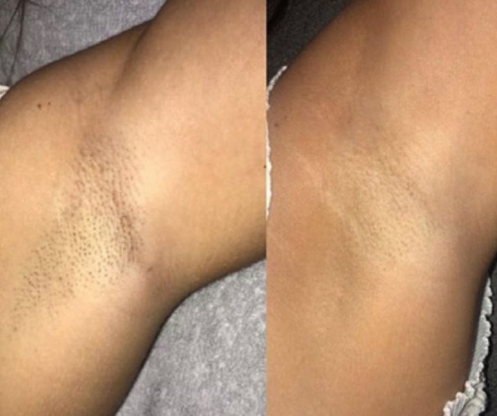 Laser Hair Removal at Get Beauty in Cambridge